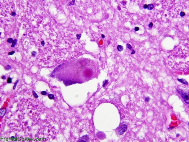 Classic Lewy body, H&E stain X600